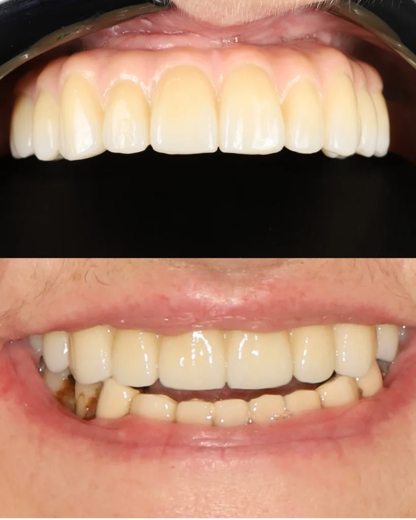 All-on-4 upper jaw