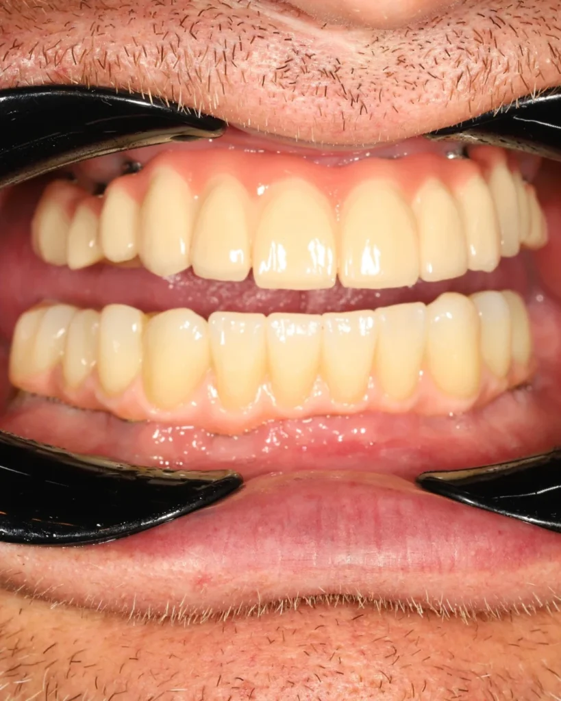 All-on-6 dental implants with zirconia bridge in Prague