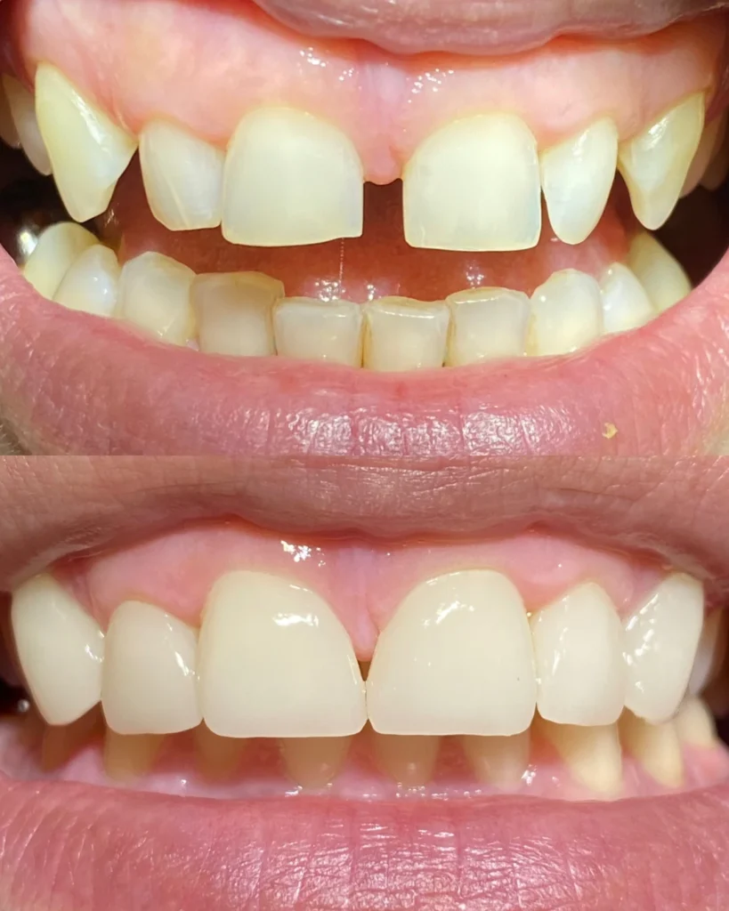 6 veneers and diastema correction