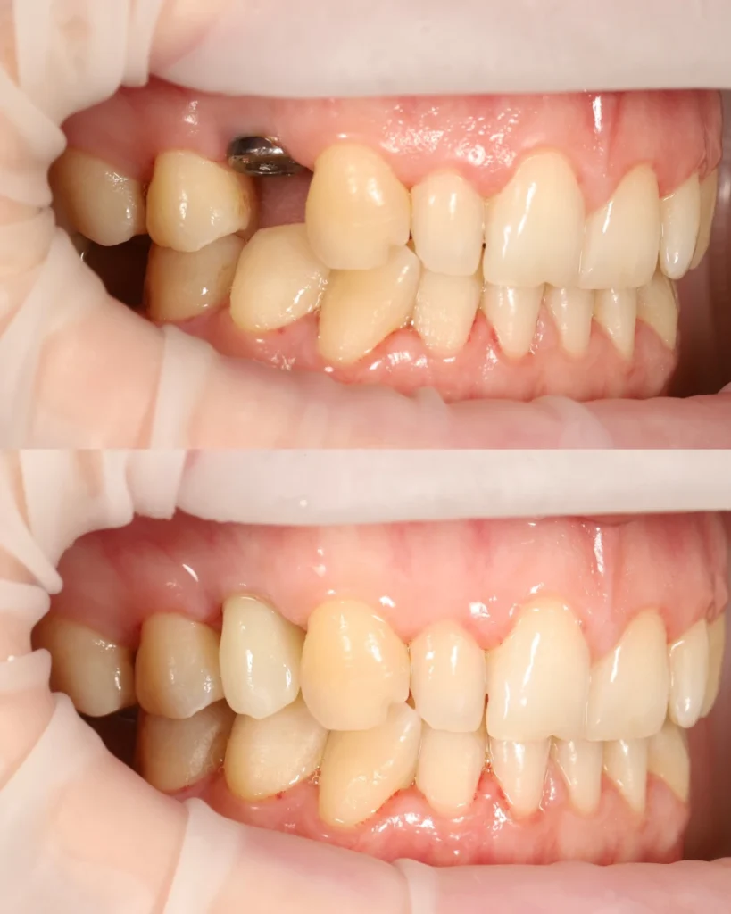 implant with full zirconia crown