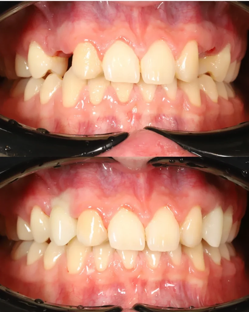 2 implants with zirconia crowns