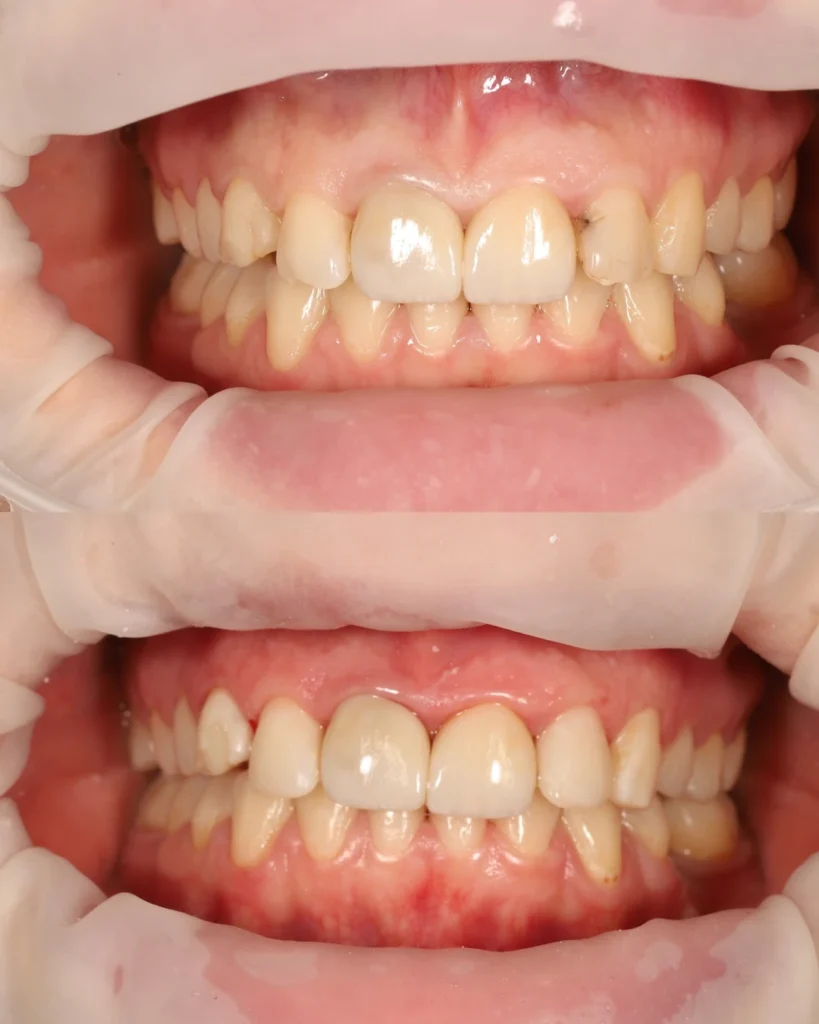 front tooth restorations before and after