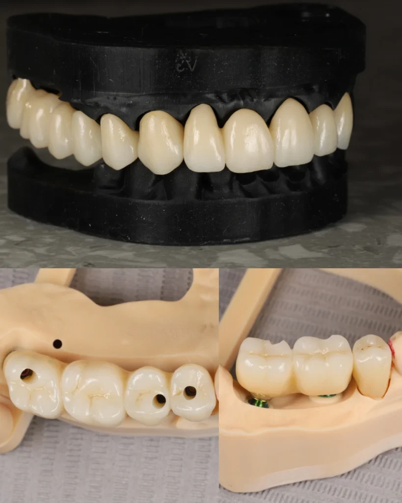 full zirconia bridges