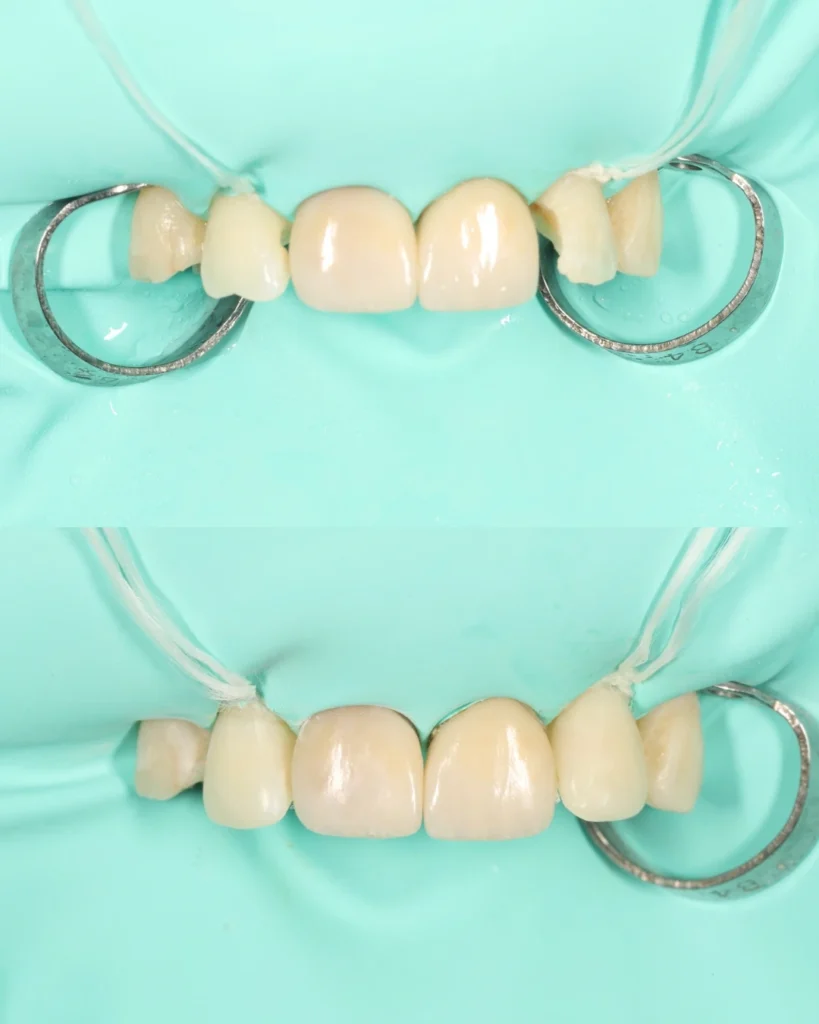 front tooth restorations