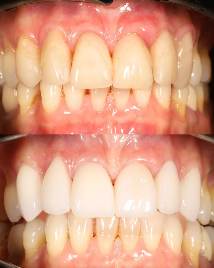 6 upper veneers replacement with new