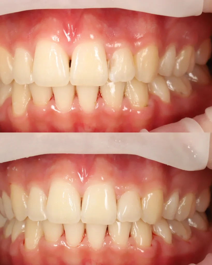 front tooth filling
