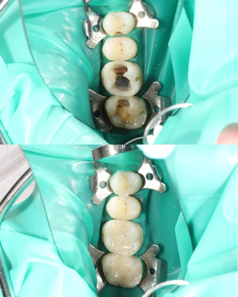 teeth filling before and after