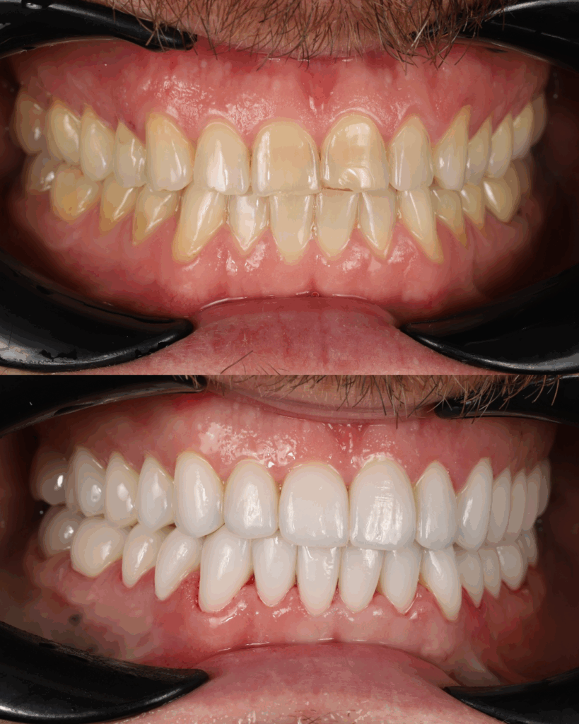 EMAX porcelain veneers before and after