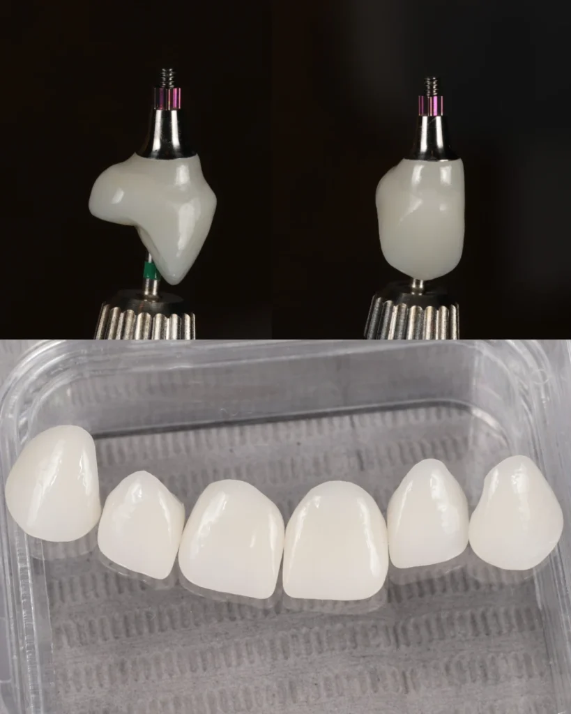 dental crown on implant and veneers