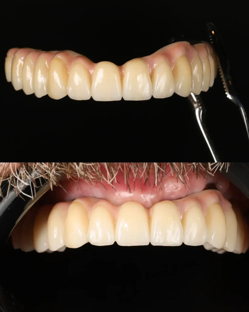 All-on-6 dental implants with zirconia bridge in Prague