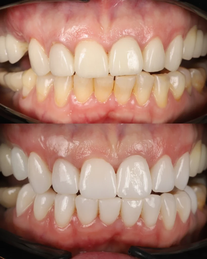 old veneers replaced with new