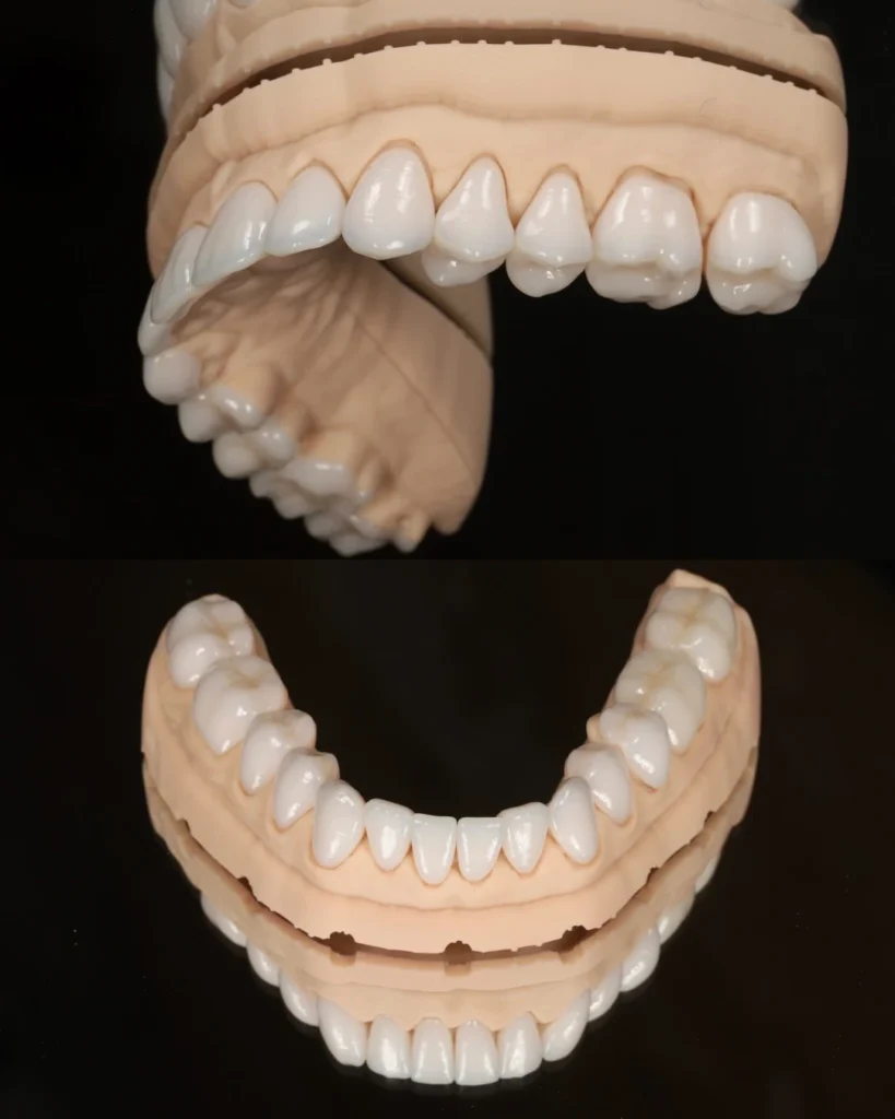 EMAX porcelain veneers on D3 printed model