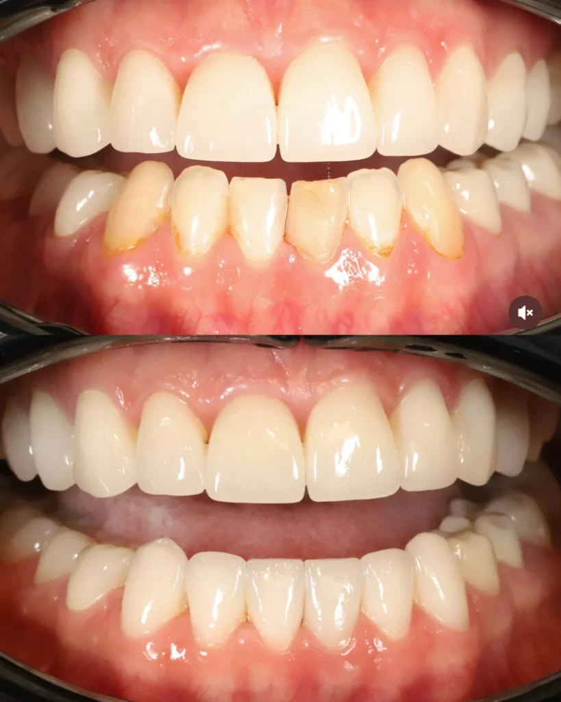 10 veneers on upper jaw and 6 veneers on lower jaw