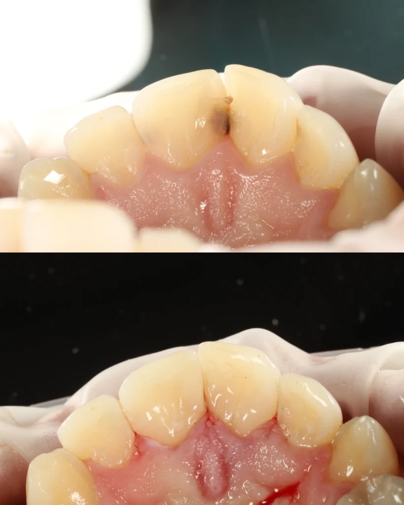 tooth filling
