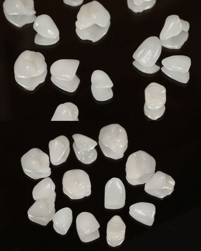 thin porcelain veneers, EMAX veneers