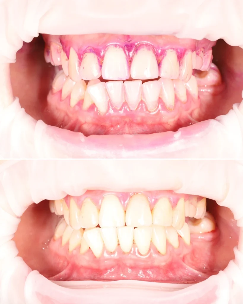 dental hygiene before/after
