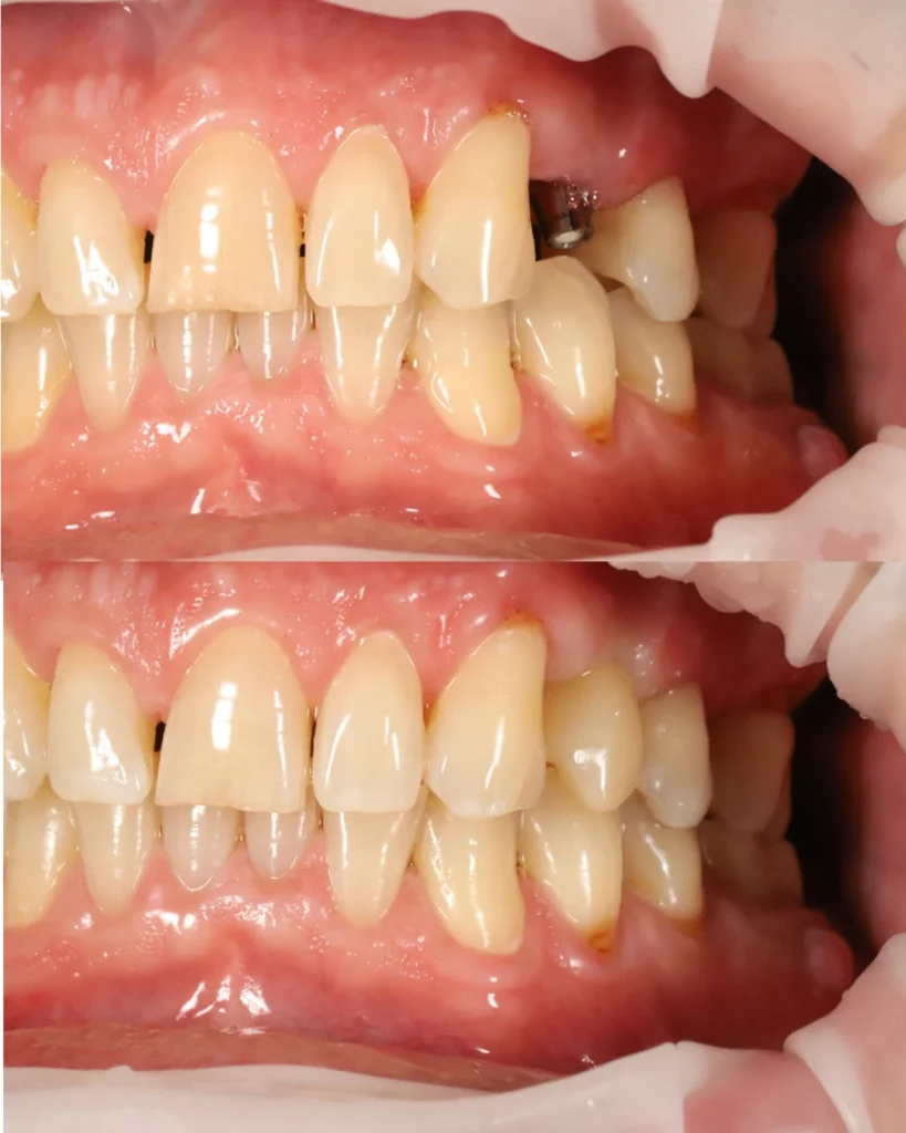 dental implant with full zirconia crown